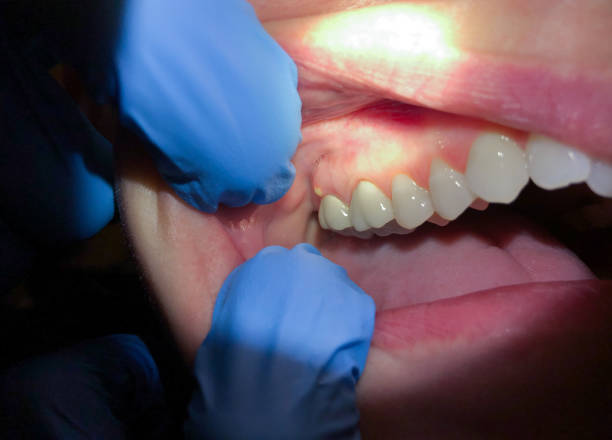 Best Emergency Dental Extractions in Fairfax Station, VA